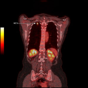 Dla Lekarzy Pozytonowa Tomografia Emisyjna Pet Tk Diagnostyka